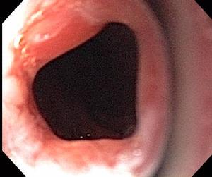 Obstructing Esophageal Stricture