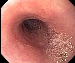 Normal Esophagus