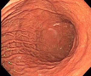 Normal Stomach