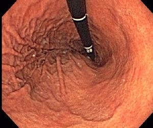 Normal Stomach Retroflexed
